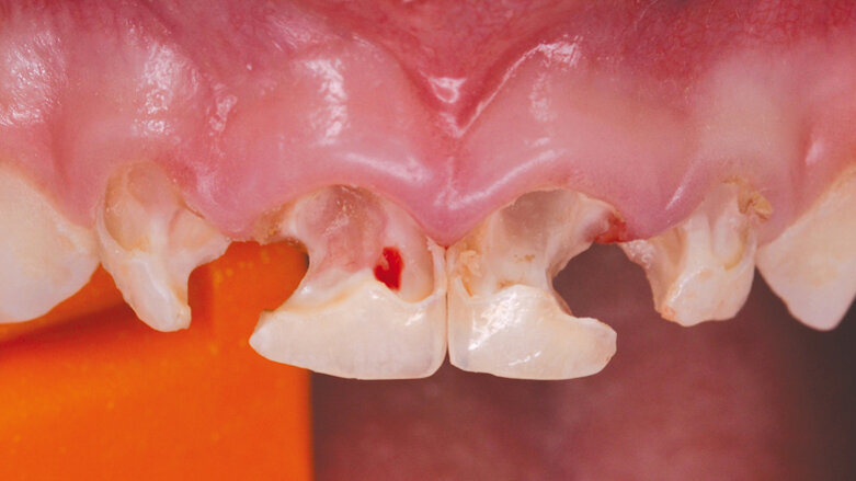 Využití CAD/CAM v pedostomatologii – kazuistika