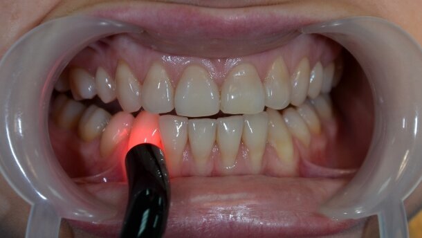 Biostymulacja laserem diodowym 635 nm w leczeniu nadwrażliwości
