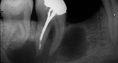 Retraitement endodontique : traiter ou ne pas traiter ?