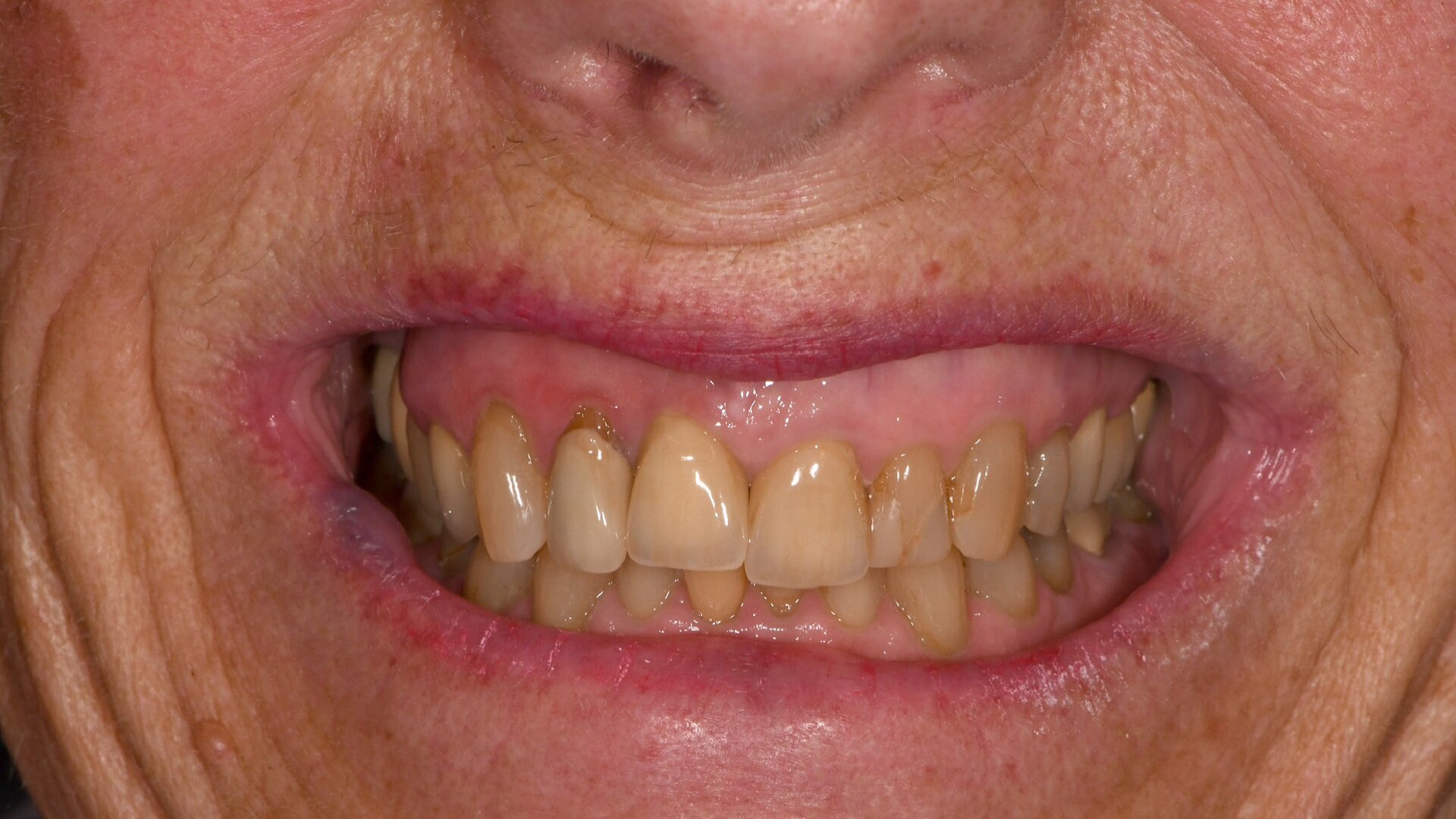 Monolithic multilayer zirconia crowns in the aesthetic zone