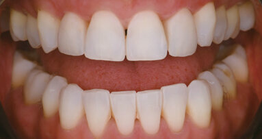 Optimising functional and aesthetic parameters in veneer cementation