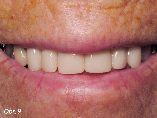 Úsměv s provizorními korunkami