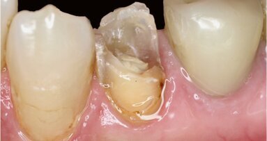 Fijación de espigas y reconstrucción de muñón en una sesión