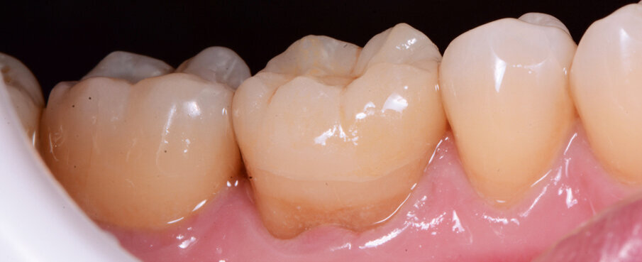 Figs. 12a & b: Lateral and occlusal views of the completed restoration.