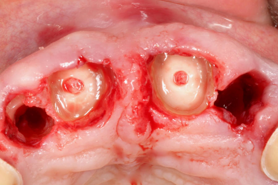 Fig. 5: Clinical situation after partial extraction of tooth #12, extraction of tooth #22, and root submersion of teeth #11 and 21.