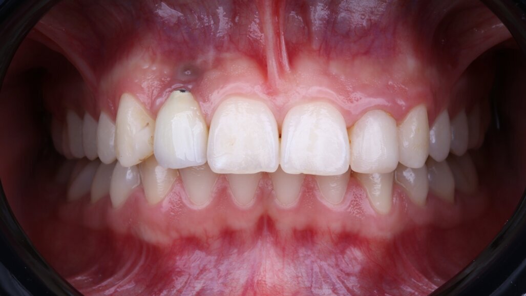 Effective strategies for managing late implant failure and peri-implantitis