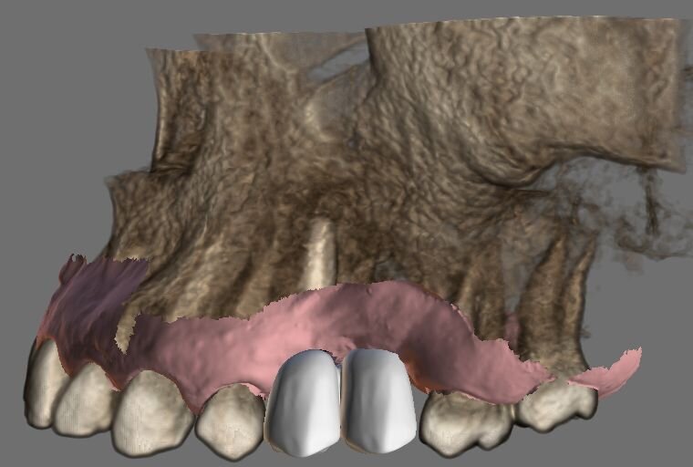 Fig. 2 - Potenza descrittiva di un’iconografia 3D nella manifestazione dei compromessi estetico-igienici per consenso informato. In questo caso la definizione dei tessuti molli e dei tessuti duri è stata ottenuto con diversi files STL; oggi esistono software di pianificazione che accettando files 3D a colori (OBJ o PLY) permettono una rappresentazione rapida di detti rapporti.