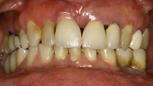 L’utilizzo di monconi in  zirconio per il miglioramento  dell’estetica rosa