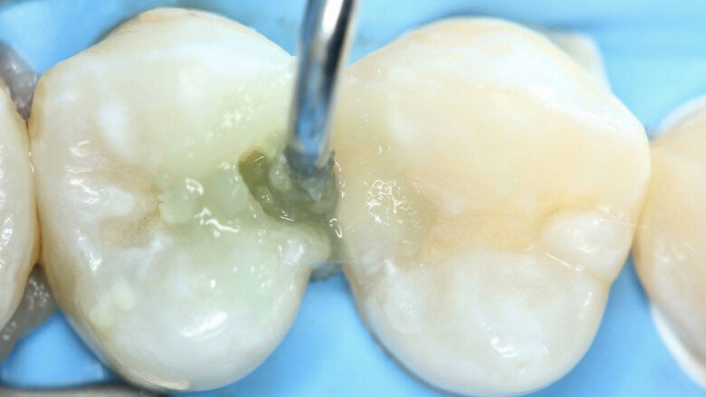 Figuras 21, 22 y 23. Se coloca a través de esa cavidad el agente enzimático Brix3000 para la remoción químico-mecánica.