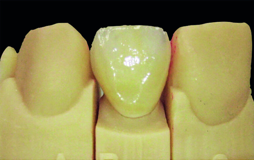 Fig. 18a: Zirconia crown on a printed model (a). Crown set in the mouth (b).