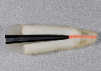 TECHOLE. One Step Fiber Post ovvero l’evoluzione della specie