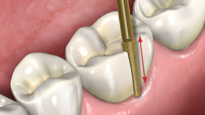 Fig. 3: The diamond-coated bur continues to be used in a direction that is parallel to its long axis,
sawing through the ceramic until either dentine (ceramic crown) or metal (porcelain-fused-to-metal crown) is encountered.