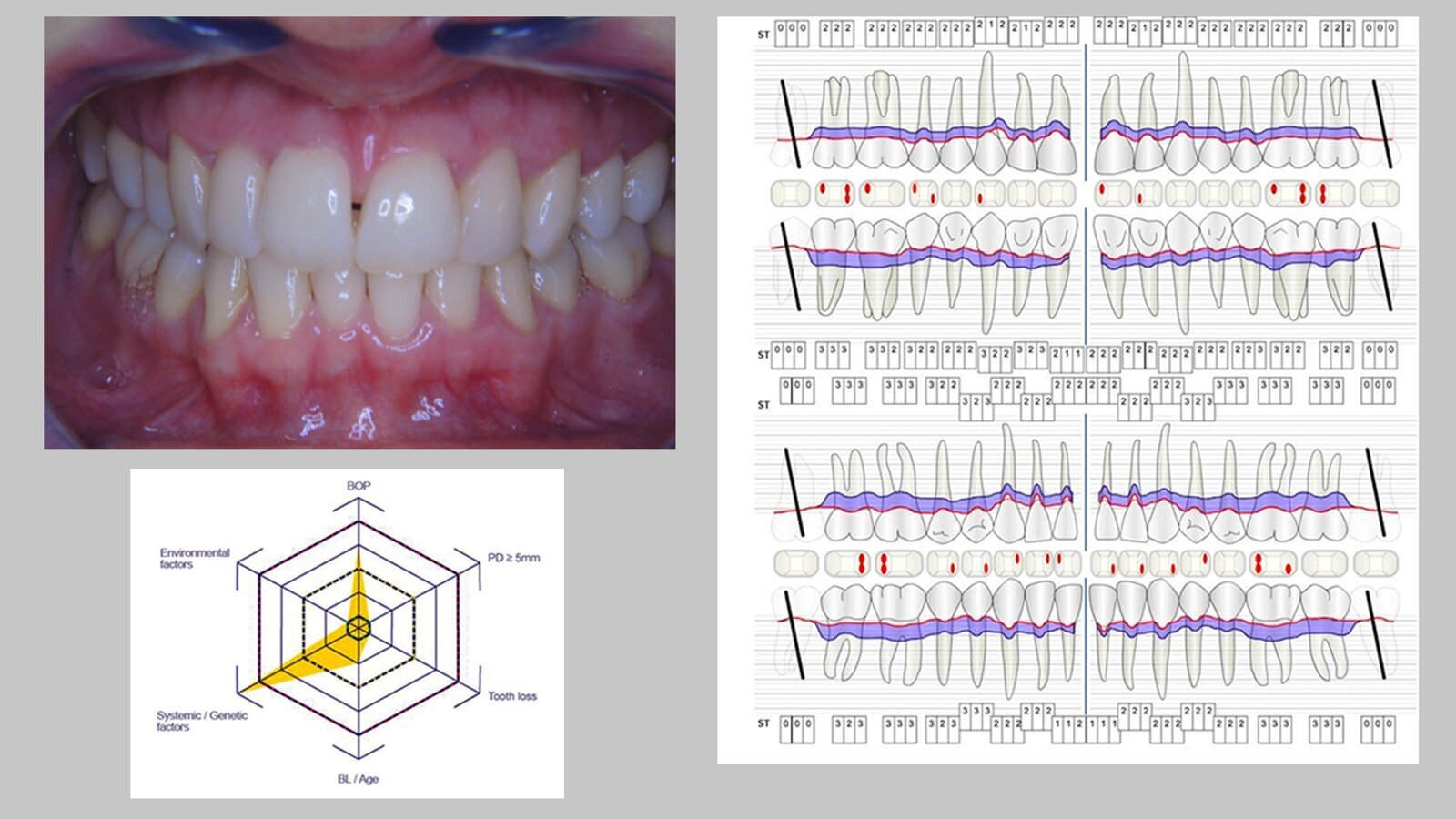 La prevención dental en pacientes diabéticos