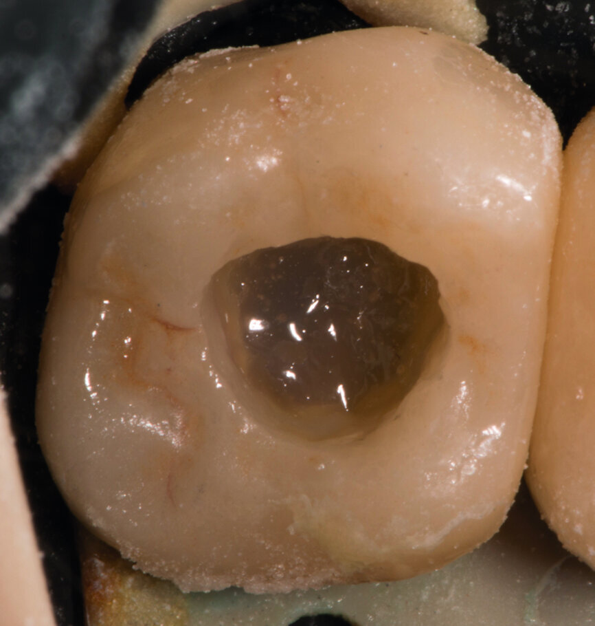 Fig. 12 : everX Posterior 