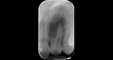 OMD promove curso de Controlo microbiológico em endodontia