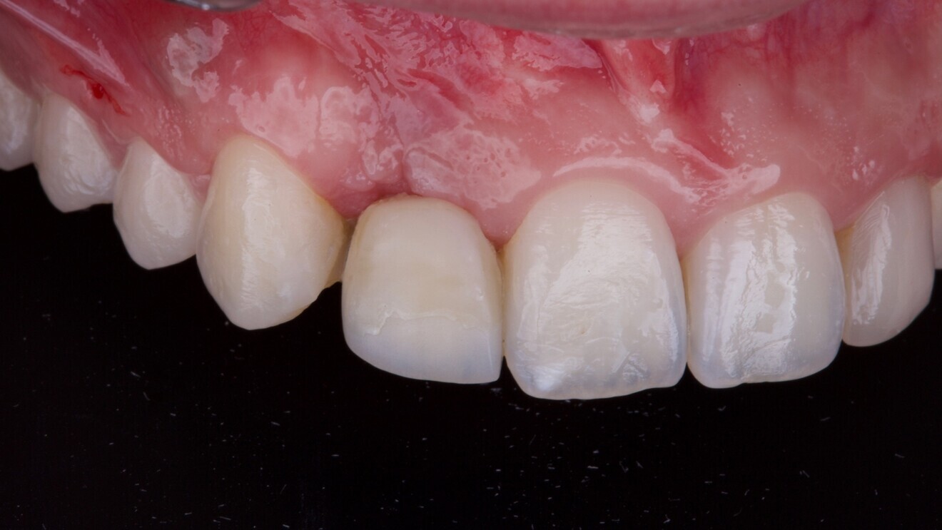 Fig. 8: Provisional screw-retained restoration placed to shape the peri-implant soft tissue. 