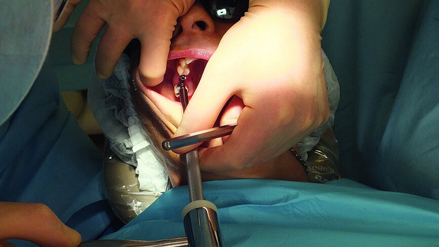 Fig. 14: The osteotome was tapped gently with a surgical mallet until the remaining thin layer of bone was infractured.