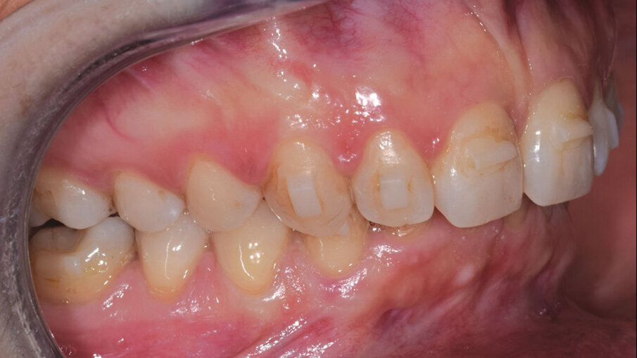 Figg. 7a-7e_Step intermedio. Lo stripping è stato eseguito con le nuove Orthostrips “Central” Intensiv. Una corretta procedura di riduzione interprossimale ci permette di recuperare spazio in arcata per ottenere la risoluzione completa dell’affollamento dentale e delle rotazioni presenti.