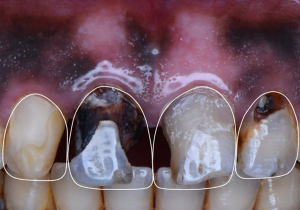 Step 1 – Digital smile design  Digital smile designing done according to golden proportions for a predictable  clinical outcome.