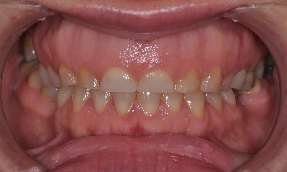 Fig. 1b: Initial clinical situation. Intra-oral view demonstrating generalised attrition and reduced incisal length.