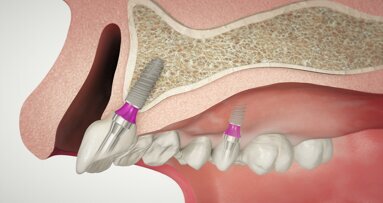 SKY fast & fixed – sistemul de implanturi care respectă promisiunea de brand