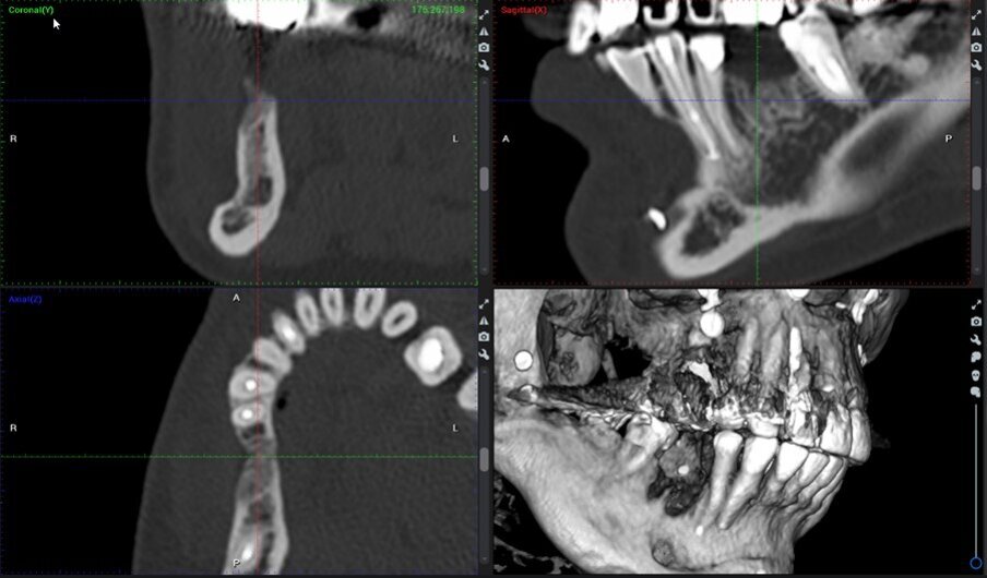 Fig. 1_Immagini CBCT pre-operatorie del sito 46.