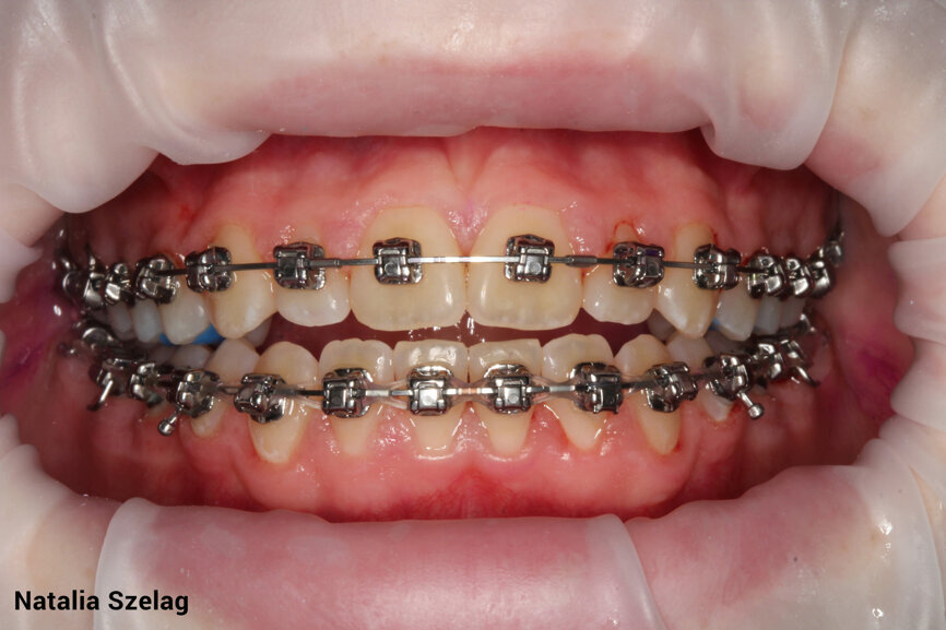 Po léčbě protokolem Guided Biofilm Therapy