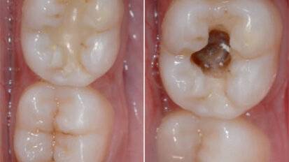 Replacement of a faulty posterior restoration