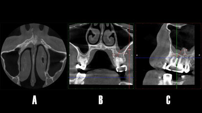 Resolución de sinusitis maxilar odontogénica mediante cirugía periapical