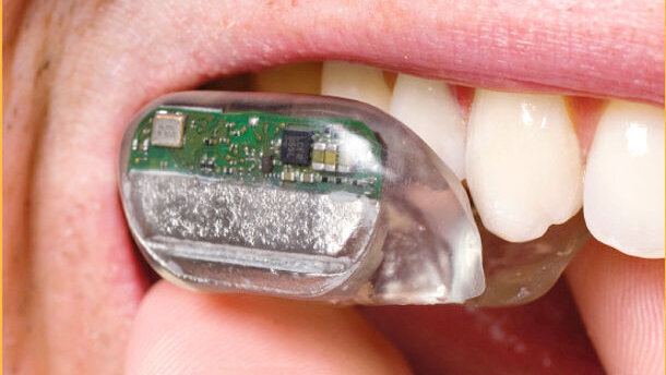 Un nouveau type d’appareil auditif sera placé dans la bouche