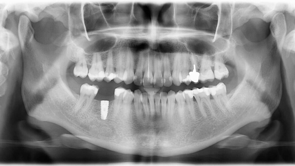Cas clinique de chirurgie guidée : « C’est la prothèse qui guide l’implant et non le contraire. »