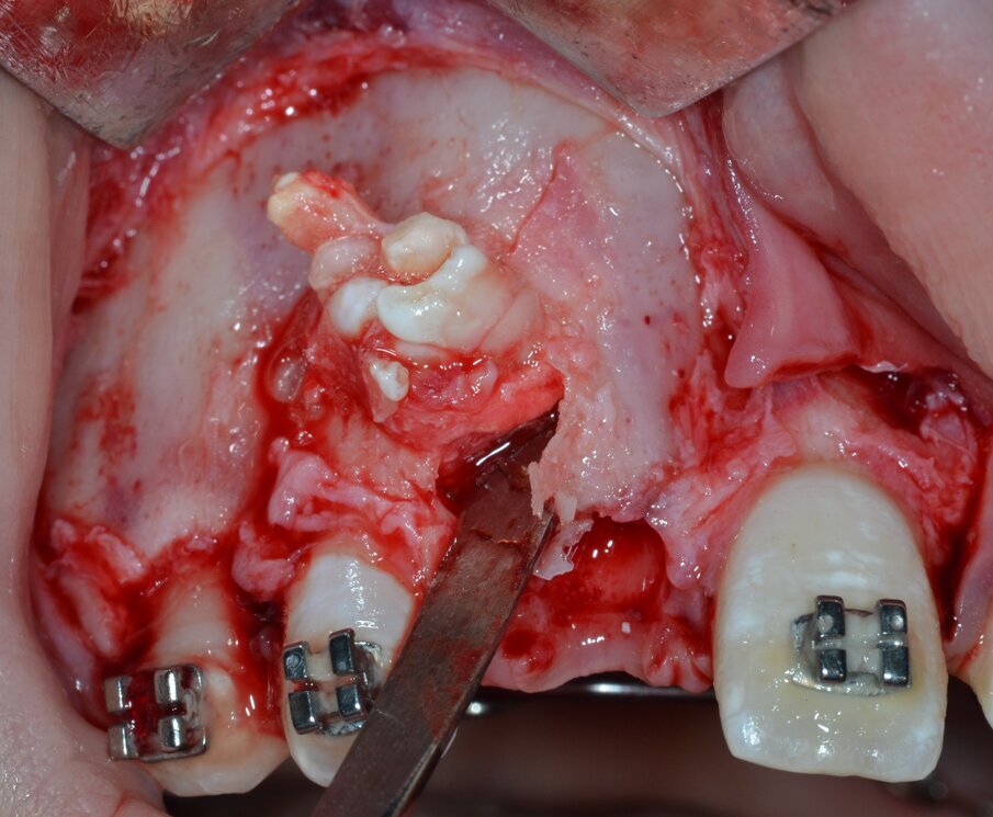 Fig. 9_Enucleazione della massa neoformata mediante una leva dritta.