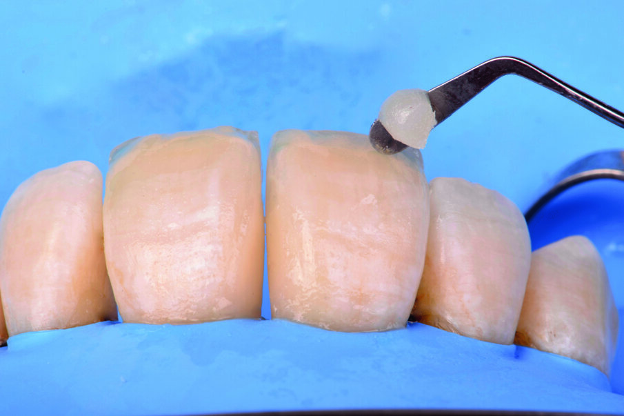 Fig 12. Build-up of incisal area  of central incisors with Beautifil II LS shade A2 and Beautifil II Enamel shade HVT