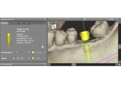 Neodent implant library now available in coDiagnostiX Guided Surgery planning software from Dental Wings