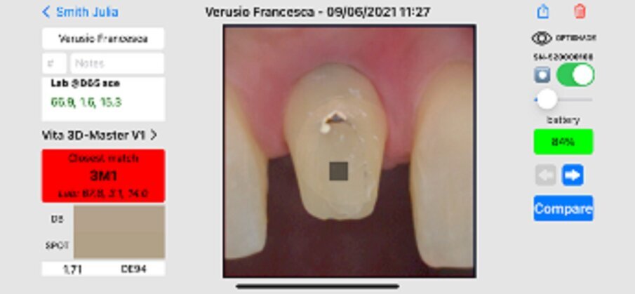 Fig. 17: Taking the shade of the prepared tooth into account.