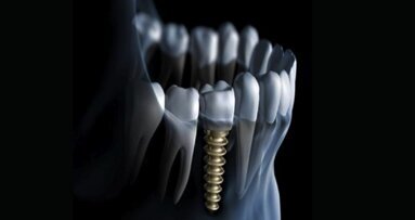 Secrets of successful dental implant placements