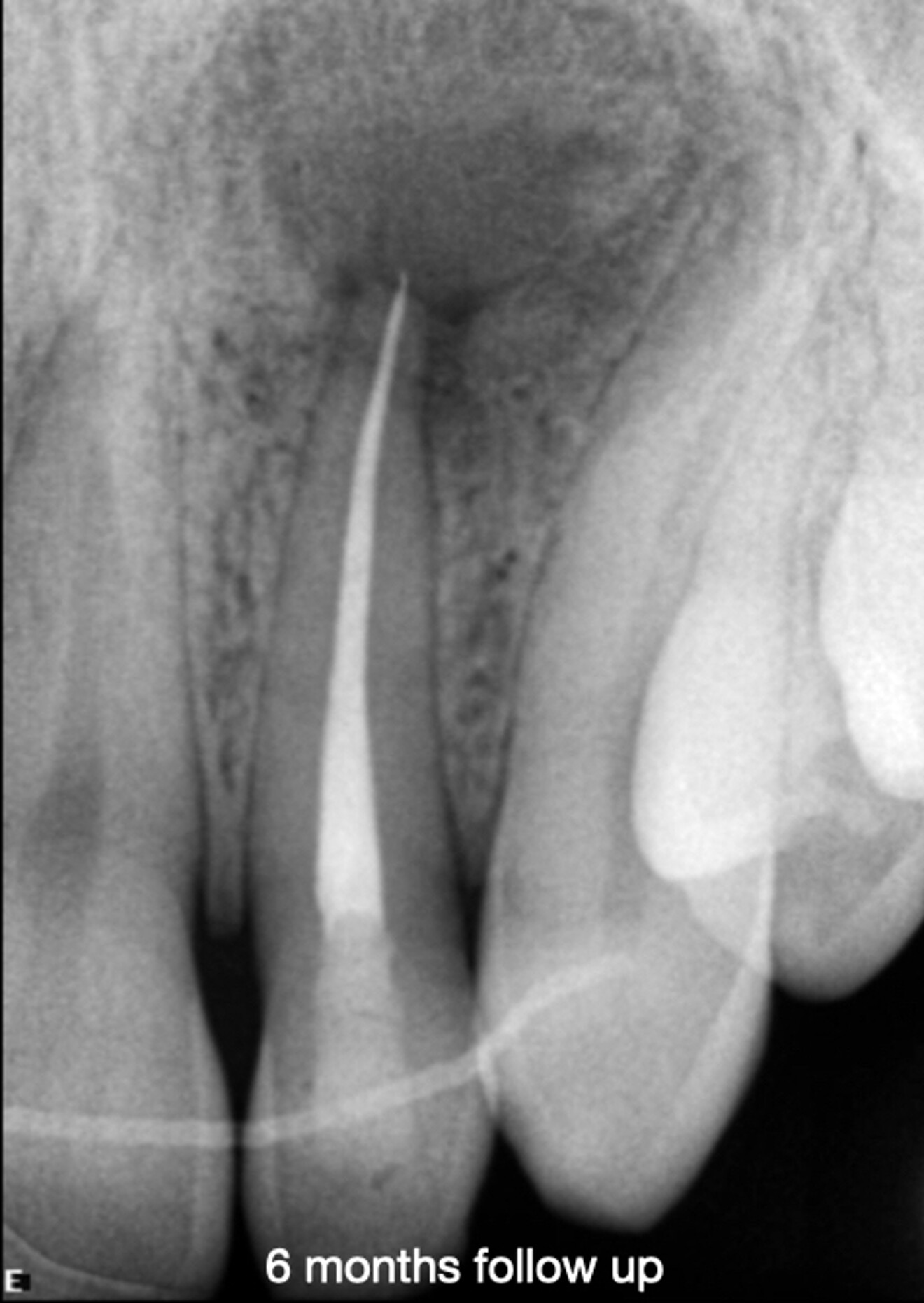 Fig. 5b: Radiograph at six months.
