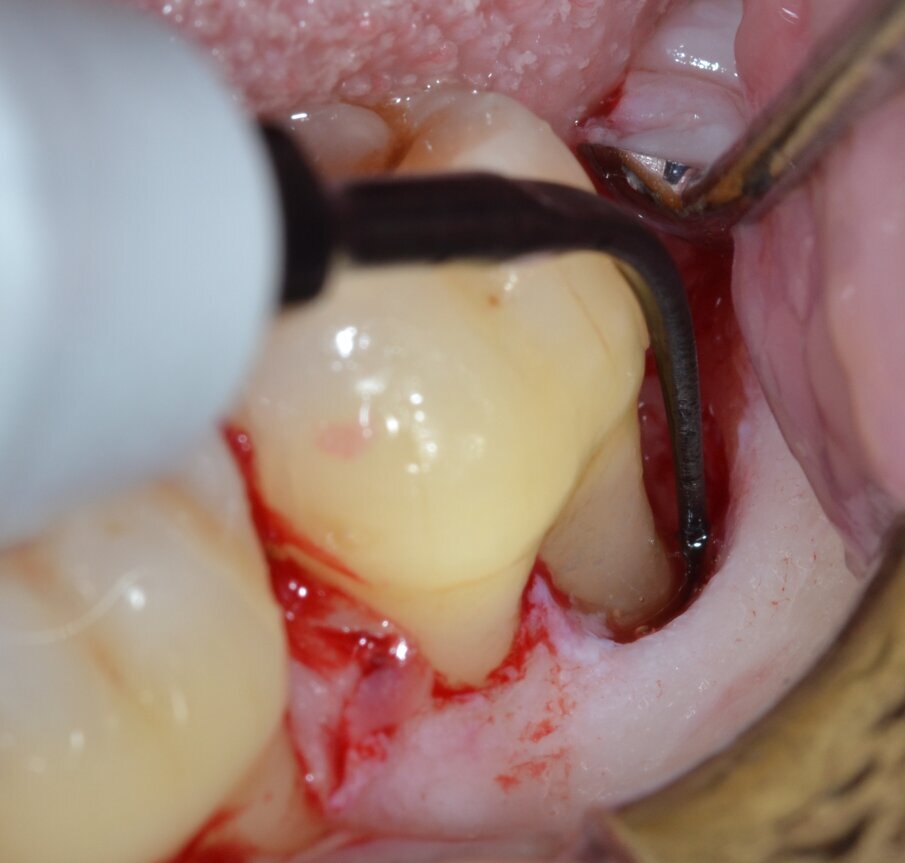 Fig. 7 - Debridement del difetto intraosseo e decontaminazione della superficie radicolare mediante ultrasuoni (aspetto distale).