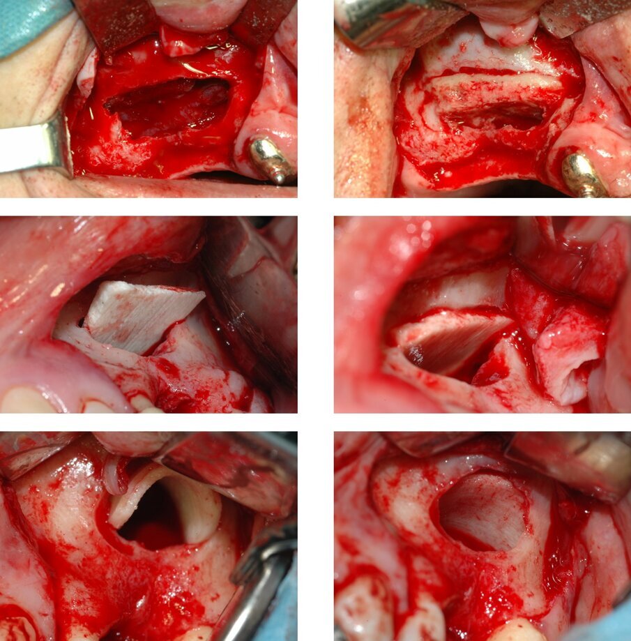 Fig. 8_Tecniche alternative di protezione della membrana sinusale facenti uso di innesti ossei di origine equina. Le prime due immagini illustrano la tradizionale tecnica di Tulasne, che vede impiegato un innesto osseo autologo prelevato da calvaria. Tale tecnica può essere mimata con una lamina di corticale equina, dello spessore di circa 2,5 mm, che può essere inserita sia “a cassetto”, creando due slot come nella tecnica di Tulasne originale (immagini della seconda riga) oppure, sfruttando il fatto che la lamina idratata diviene flessibile, inserendola piegata nella cavità e lasciando che, per elasticità, essa si distenda al di sotto della membrana (ultime due immagini). 