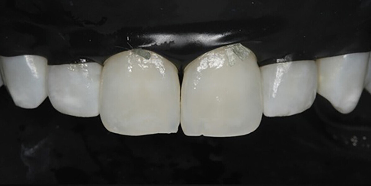 Fig. 4b: Immediately after resin inltration treatment.