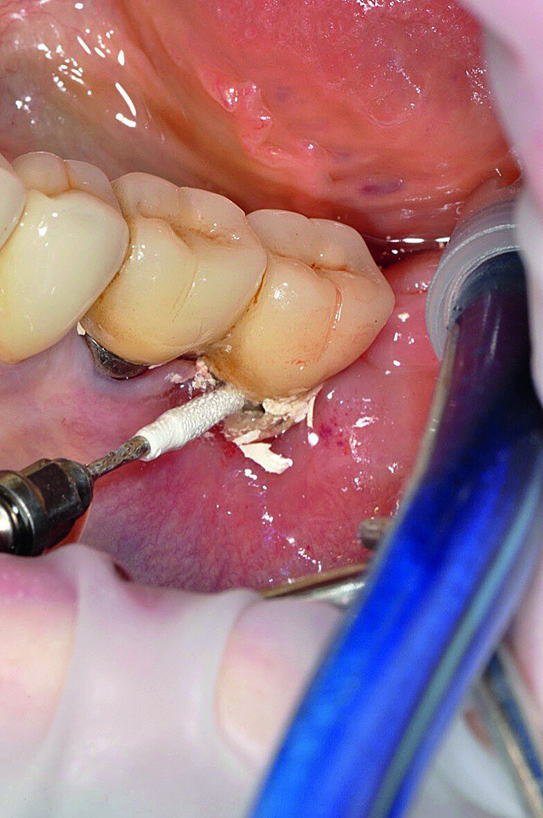 Fig. 7: Careful removal of excess cement after prosthesis cementation using a PEEK tip (PI).