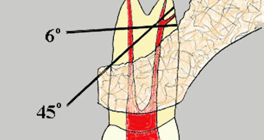 Apical microsurgery: the REB and REP (Part 4)