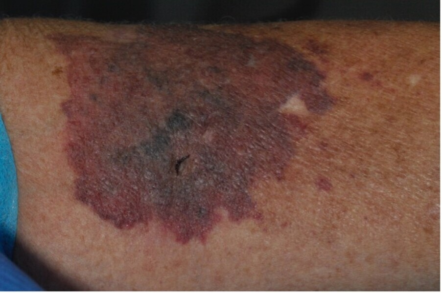 Fig. 4 : Manifestation cutanée idiopathique survenu chez cette patiente ayant bénéficié d’implant 4–5 ans auparavant. La patiente a commencé par perdre certains implants sans manifestation infectieuse majeure. Les signes dermatologiques se sont aggravés lors de la mise en place des piliers prothétiques.