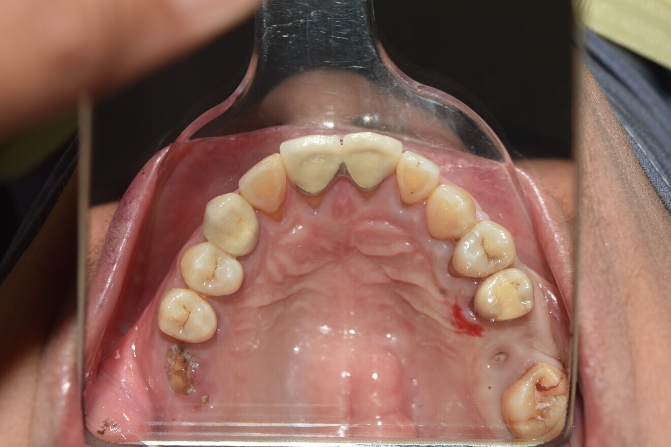 Fig. 6: Four years later without additional retention (essix missing)