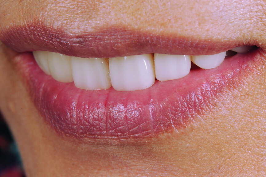 Fig. 30: Four-year follow-up: lateral view of smile.