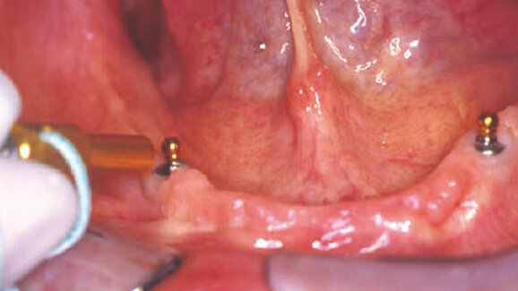 Soluzioni per attacchi