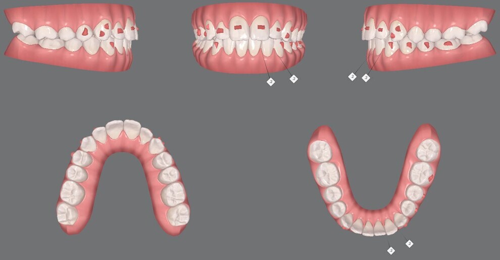Figs. 14a–e: Mid-treatment digital models.