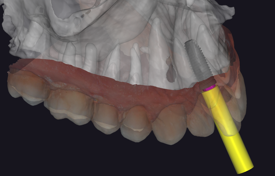 Fig. 8a: Virtual implant placement in exoplan in region #11, showing the location relative to the adjacent crowns and roots, lateral view.