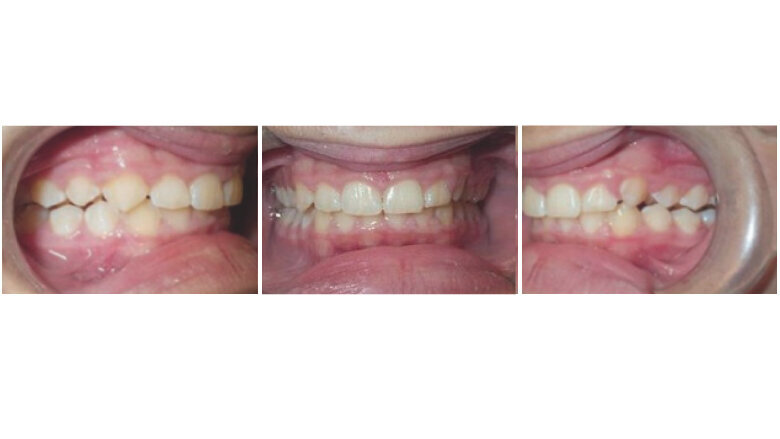End of mandibular advancement phase after 11 months (initial aligners: U:27, L:27)