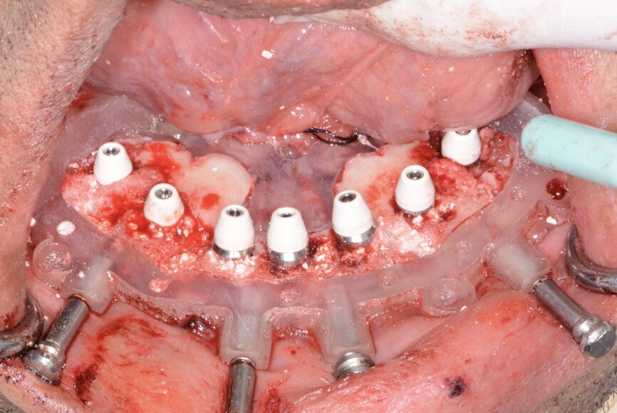 Fig. 18: Implants with corresponding multi-unit abutments.
